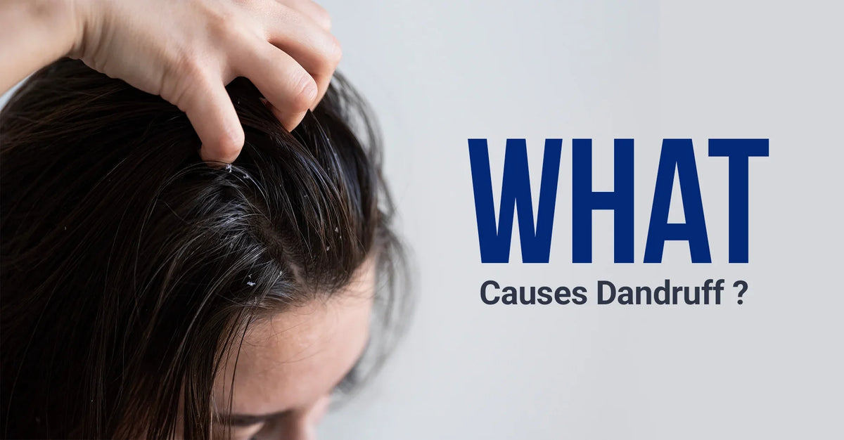 What Causes Dandruff? Common Triggers and How to Care for Your Scalp